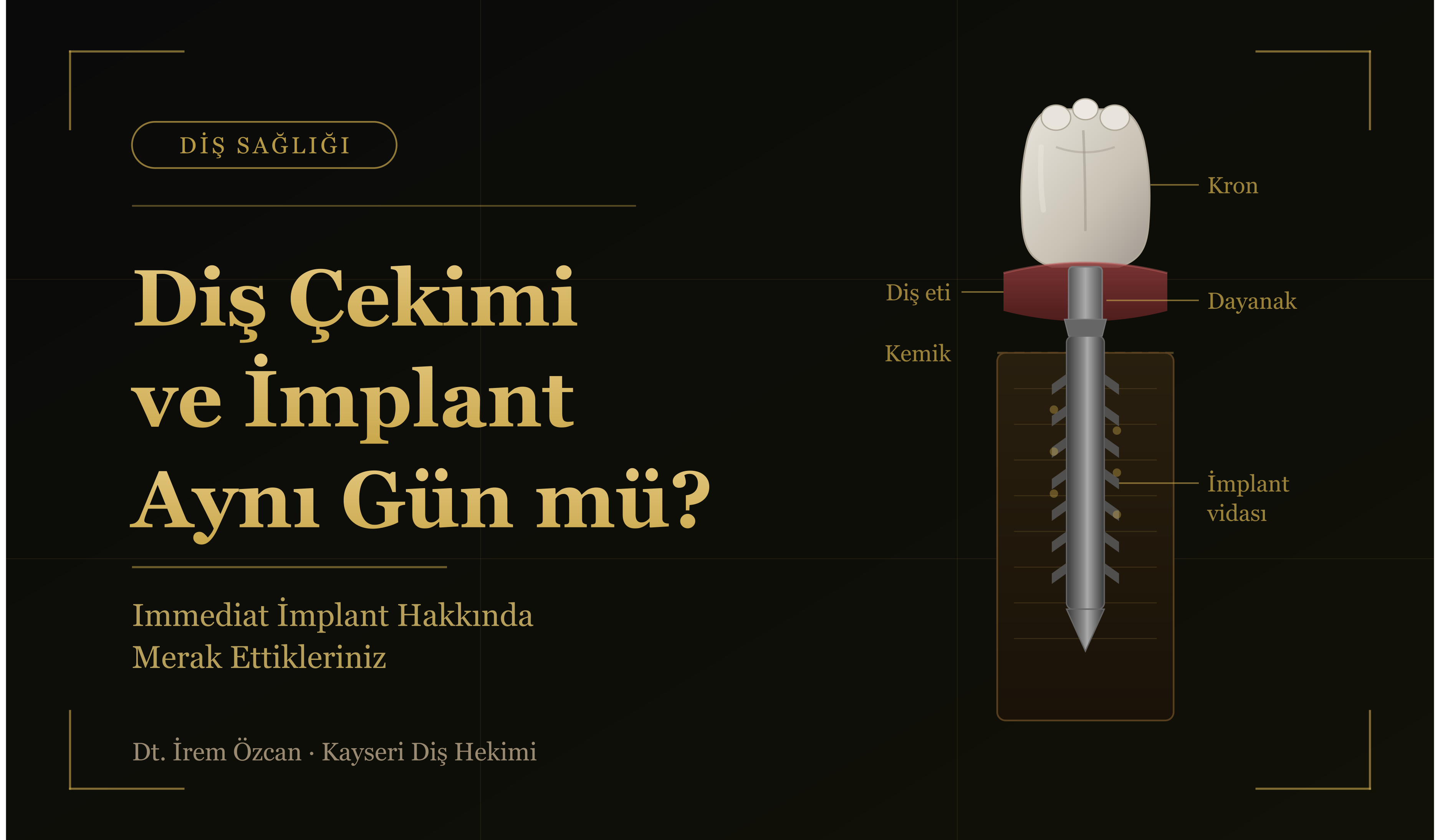 Implant - Dt. İrem Özcan
