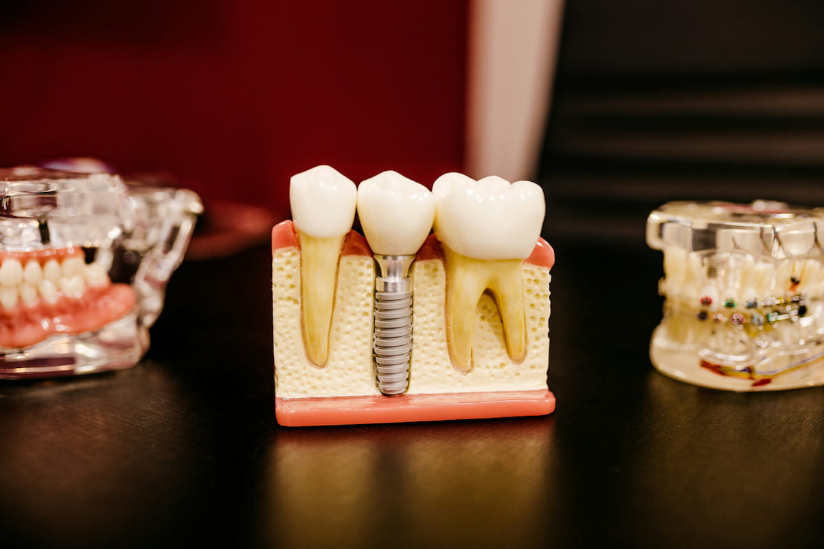 Modern diş kliniğinde implant tedavisi